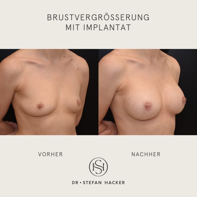 brustvergroesserung_vorher_nachher