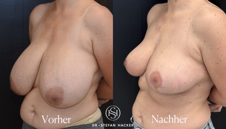 brustverkleinerung_vorher_nachher_F_auf_C_dr-stefan-hacker